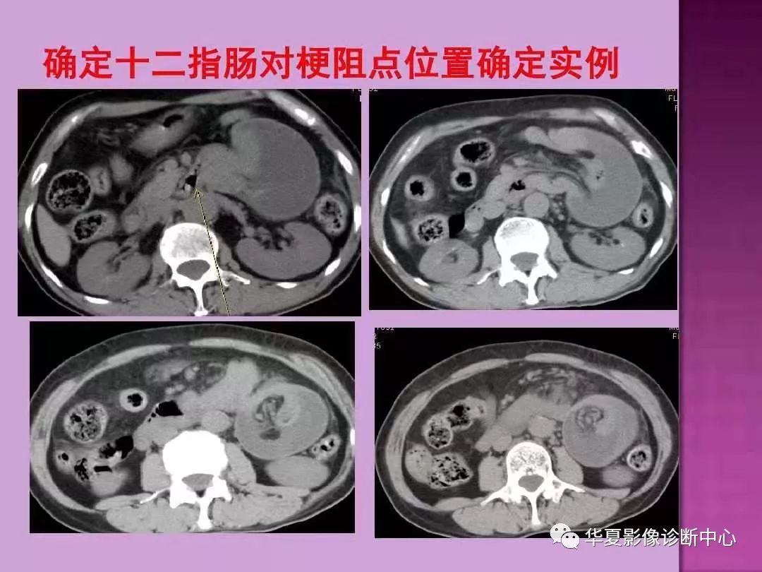 【PPT】小肠梗阻的CT诊断—肠梗阻的梗阻点的寻找