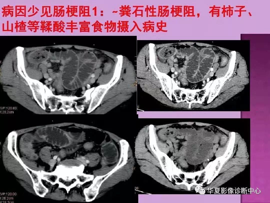 【PPT】小肠梗阻的CT诊断—肠梗阻的梗阻点的寻找