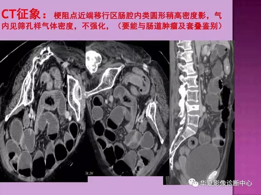 【PPT】小肠梗阻的CT诊断—肠梗阻的梗阻点的寻找