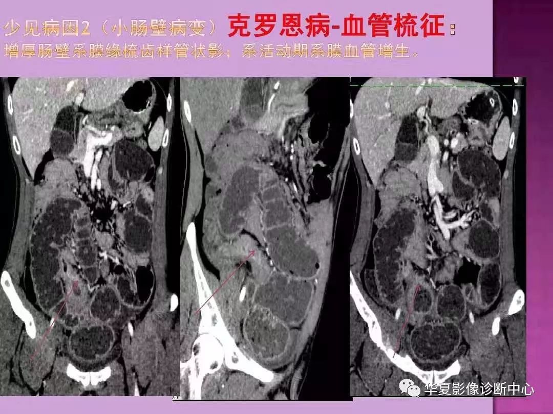 【PPT】小肠梗阻的CT诊断—肠梗阻的梗阻点的寻找