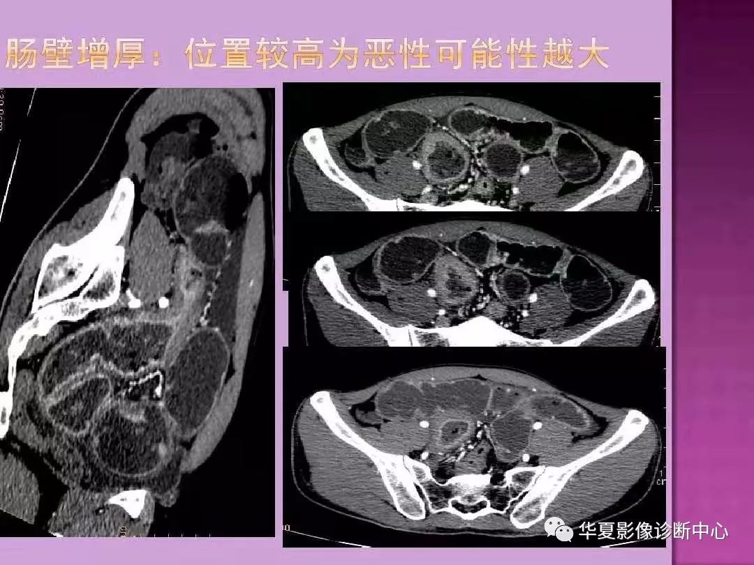 【PPT】小肠梗阻的CT诊断—肠梗阻的梗阻点的寻找