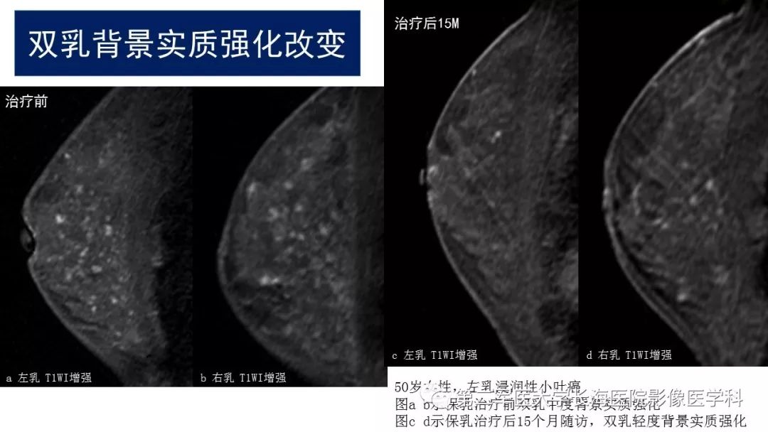 【PPT】乳腺癌保乳治疗后常见MR表现