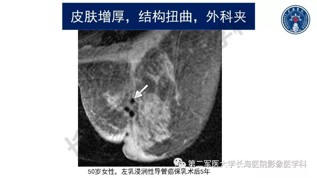 【PPT】乳腺癌保乳治疗后常见MR表现