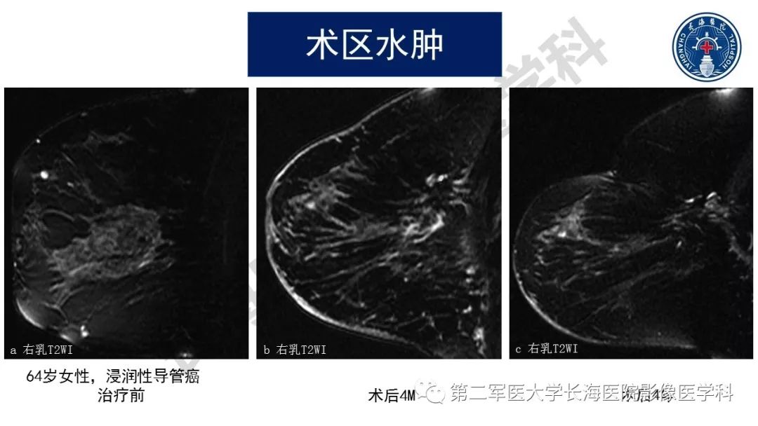 【PPT】乳腺癌保乳治疗后常见MR表现