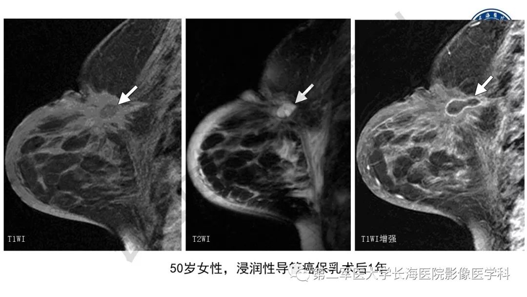 【PPT】乳腺癌保乳治疗后常见MR表现