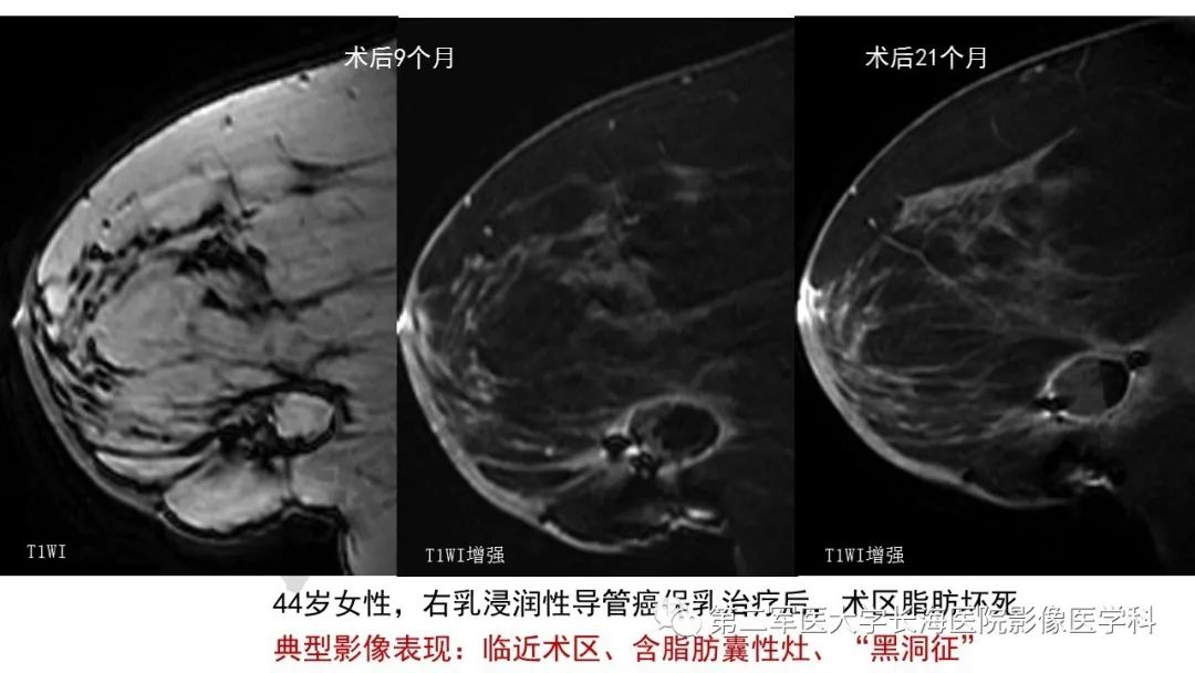【PPT】乳腺癌保乳治疗后常见MR表现
