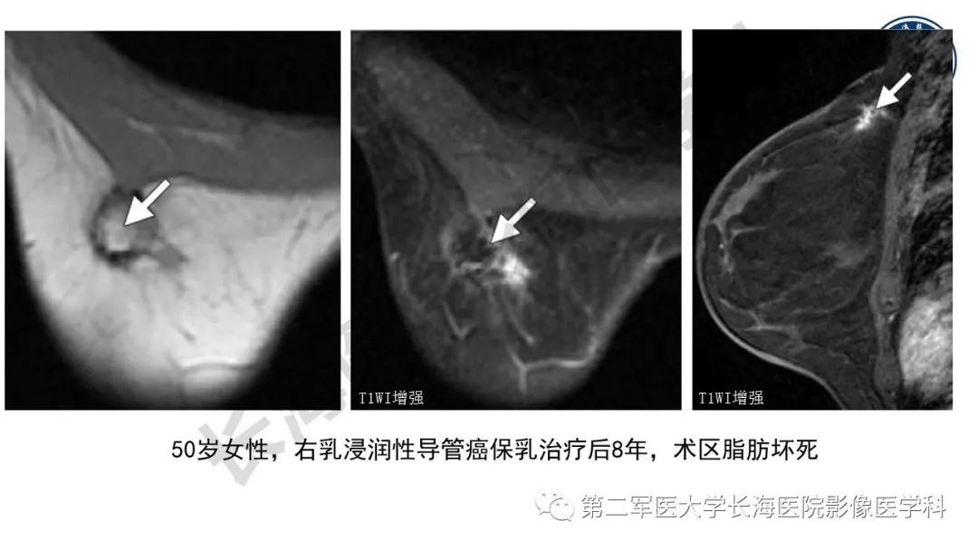 【PPT】乳腺癌保乳治疗后常见MR表现