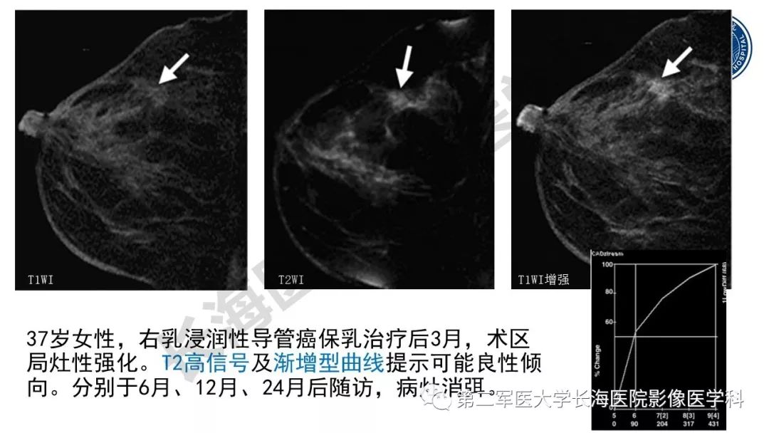 【PPT】乳腺癌保乳治疗后常见MR表现