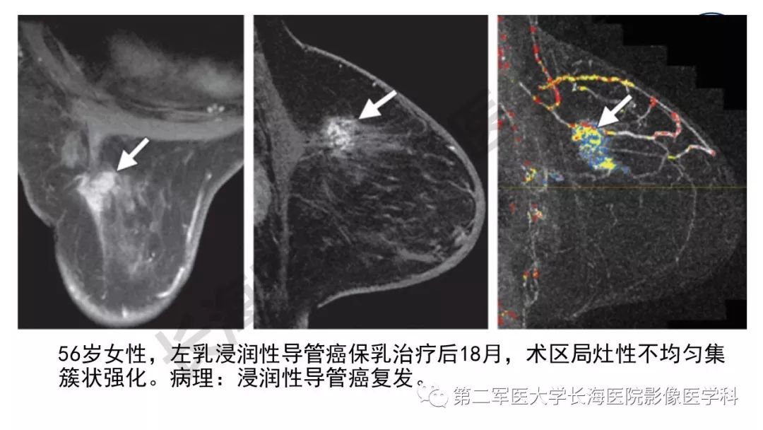 【PPT】乳腺癌保乳治疗后常见MR表现