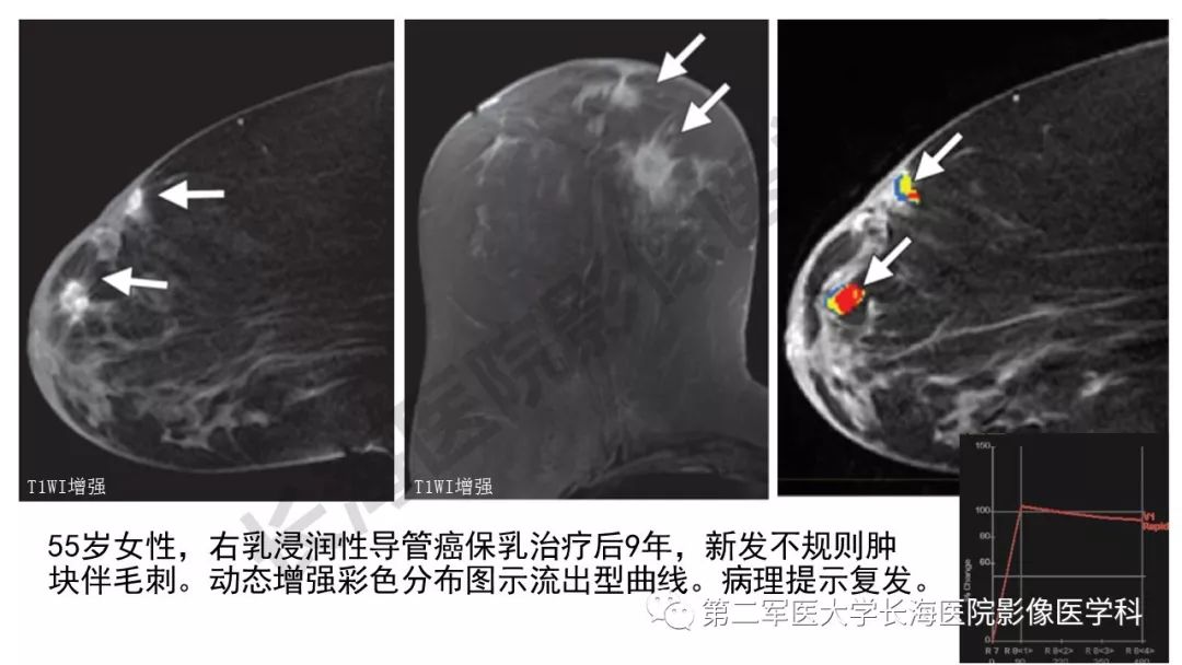 【PPT】乳腺癌保乳治疗后常见MR表现