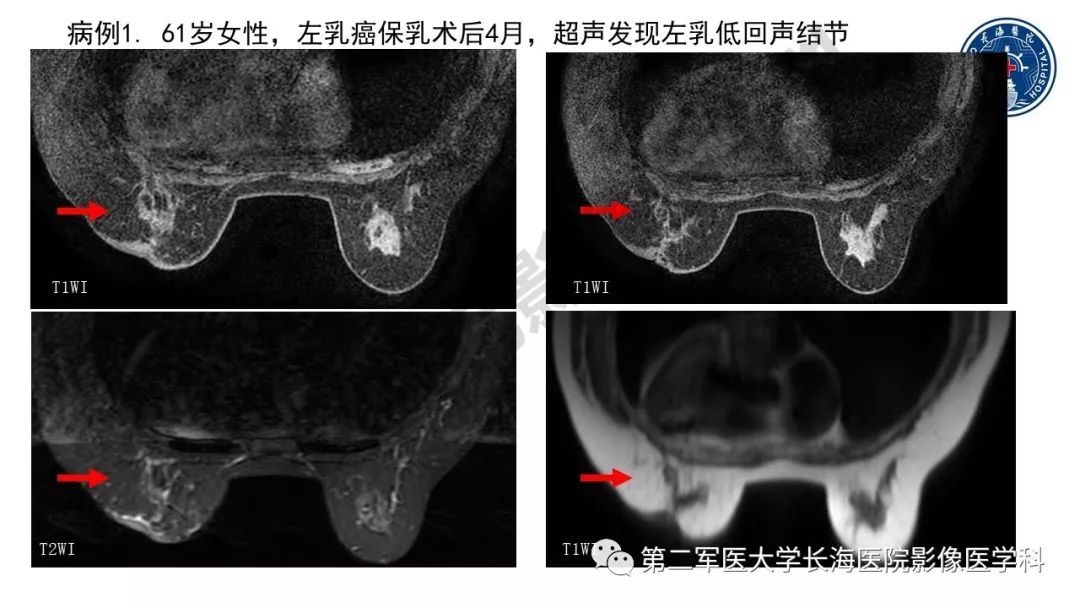【PPT】乳腺癌保乳治疗后常见MR表现