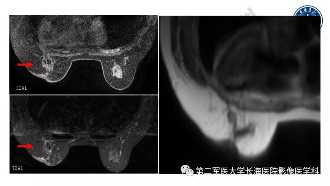 【PPT】乳腺癌保乳治疗后常见MR表现