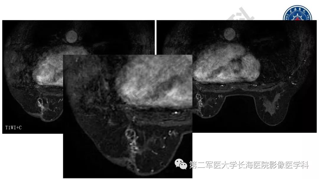 【PPT】乳腺癌保乳治疗后常见MR表现