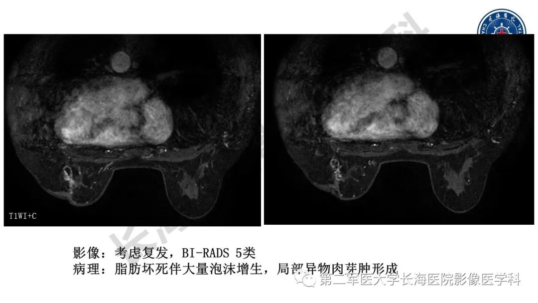 【PPT】乳腺癌保乳治疗后常见MR表现