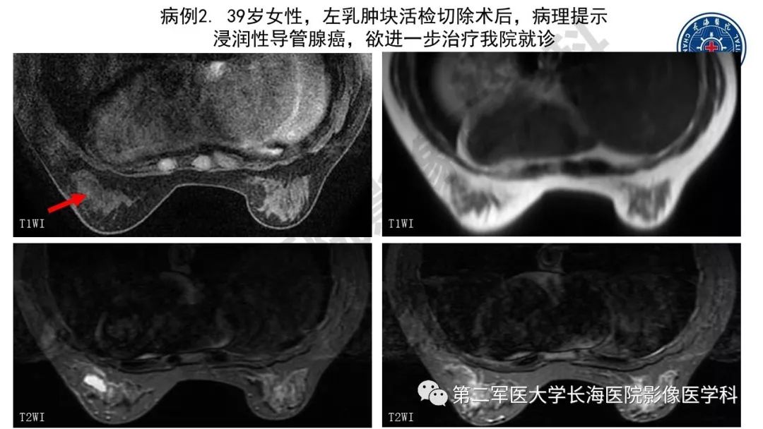 【PPT】乳腺癌保乳治疗后常见MR表现