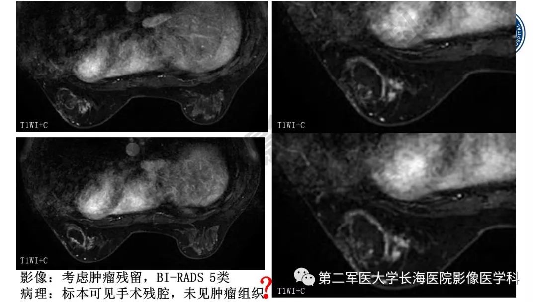 【PPT】乳腺癌保乳治疗后常见MR表现