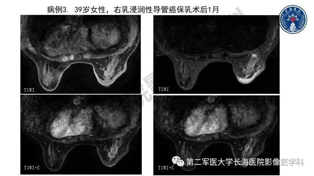 【PPT】乳腺癌保乳治疗后常见MR表现