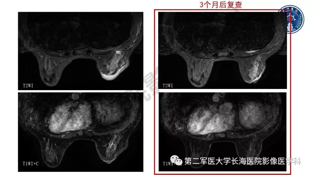 【PPT】乳腺癌保乳治疗后常见MR表现