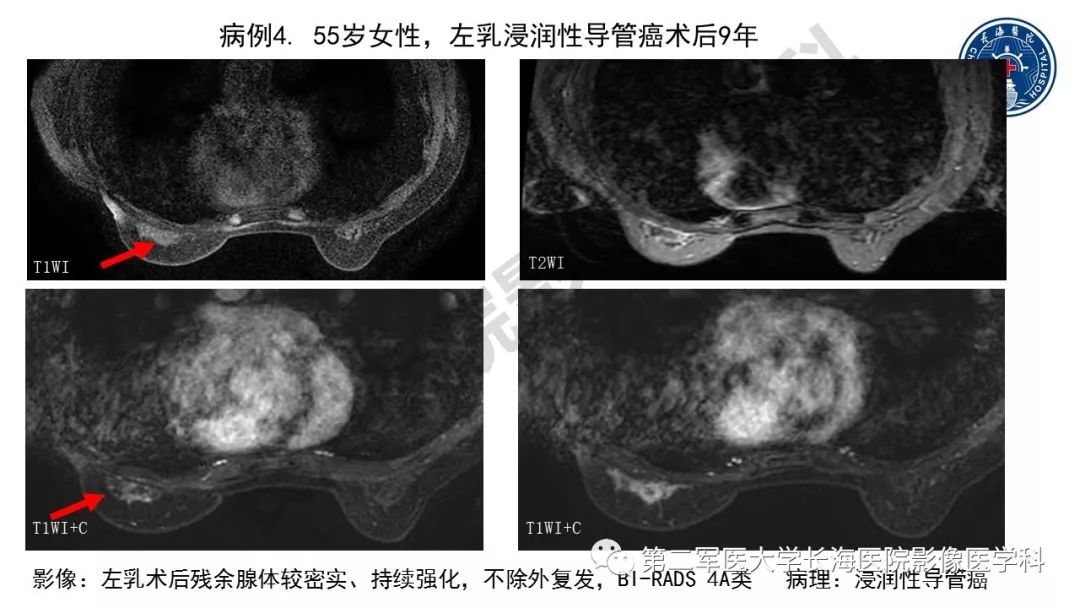 【PPT】乳腺癌保乳治疗后常见MR表现