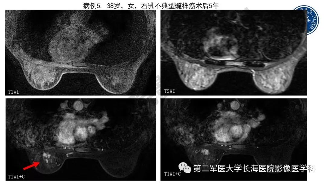 【PPT】乳腺癌保乳治疗后常见MR表现