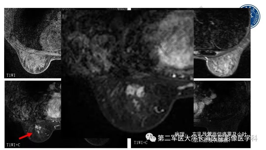 【PPT】乳腺癌保乳治疗后常见MR表现