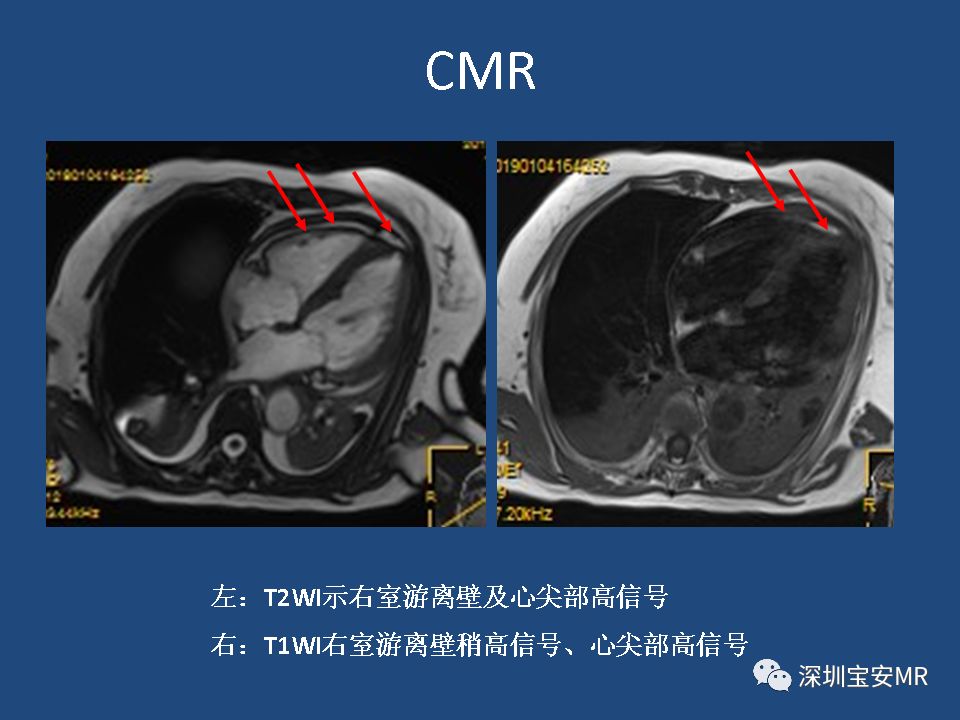 【病例】致心律失常性右室心肌病2例MR影像