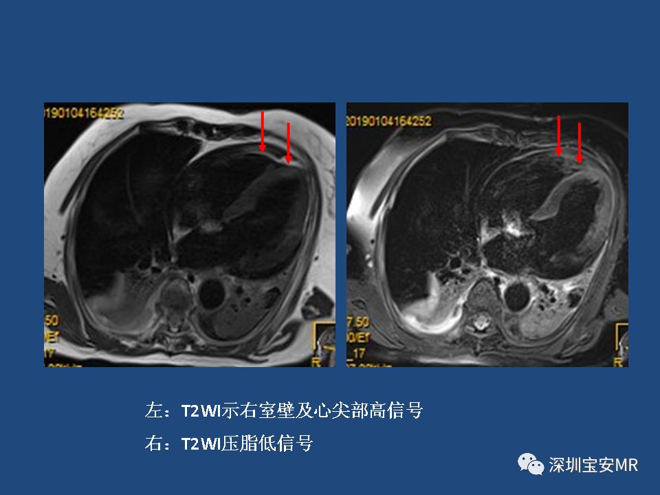 【病例】致心律失常性右室心肌病2例MR影像