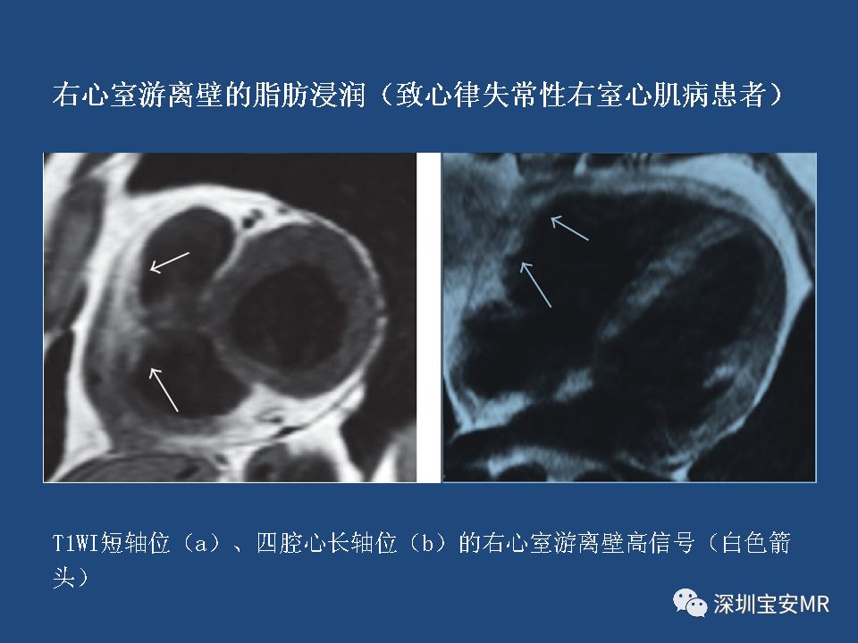 【病例】致心律失常性右室心肌病2例MR影像