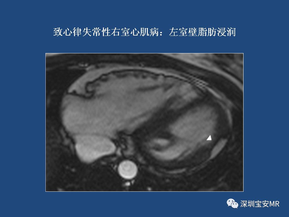 【病例】致心律失常性右室心肌病2例MR影像