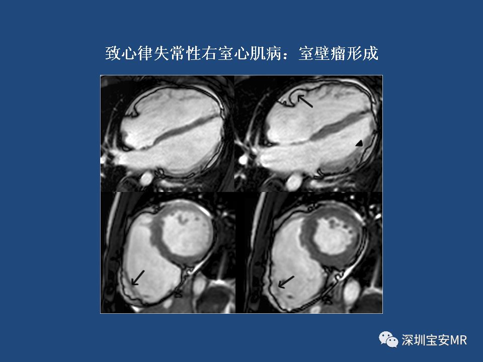 【病例】致心律失常性右室心肌病2例MR影像
