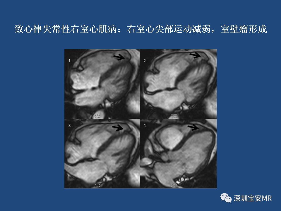 【病例】致心律失常性右室心肌病2例MR影像