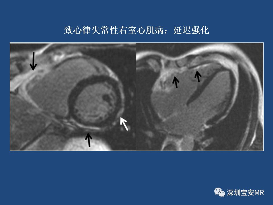 【病例】致心律失常性右室心肌病2例MR影像