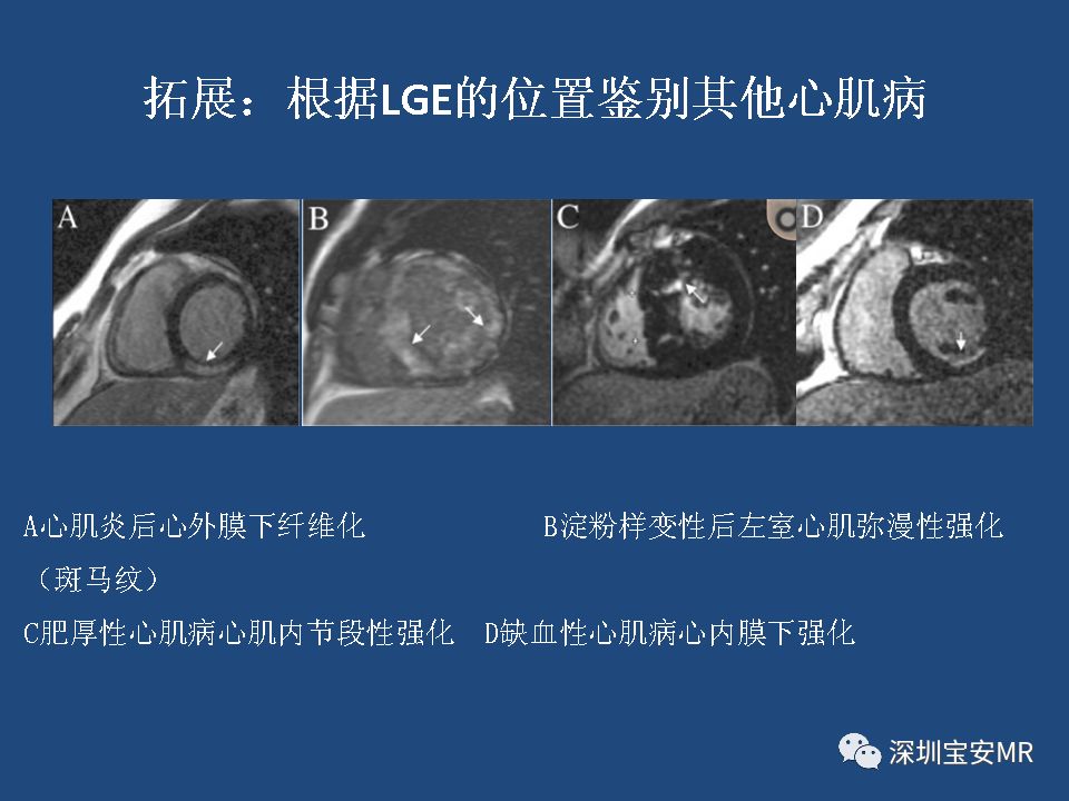 【病例】致心律失常性右室心肌病2例MR影像