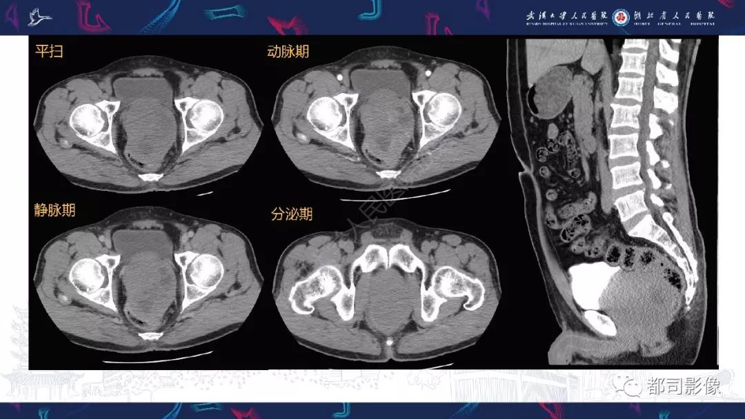 【PPT】前列腺胃肠外间质瘤影像诊断