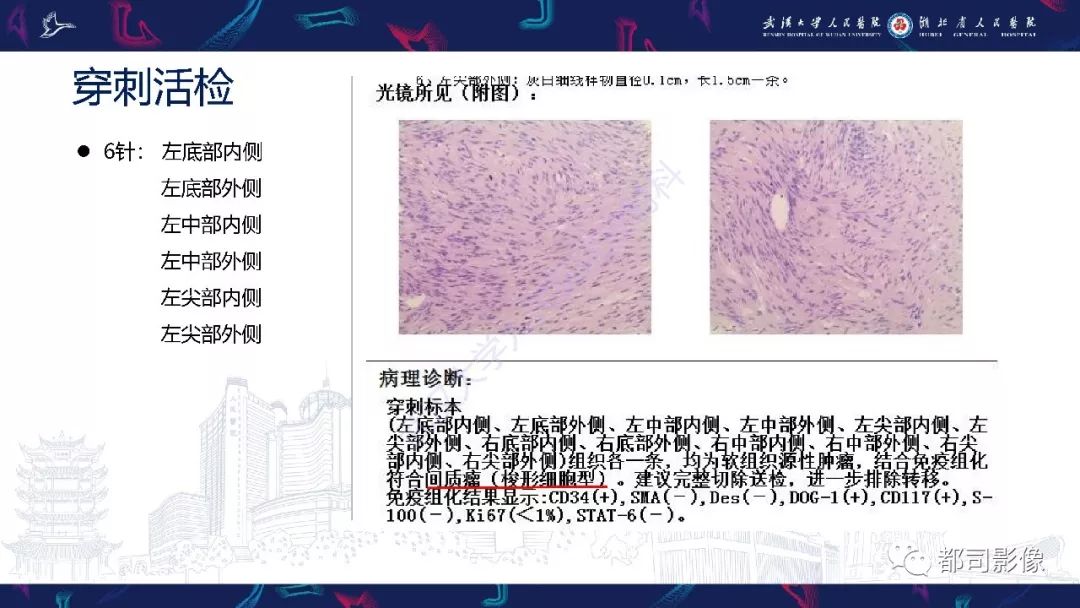 【PPT】前列腺胃肠外间质瘤影像诊断