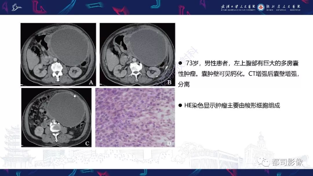 【PPT】前列腺胃肠外间质瘤影像诊断