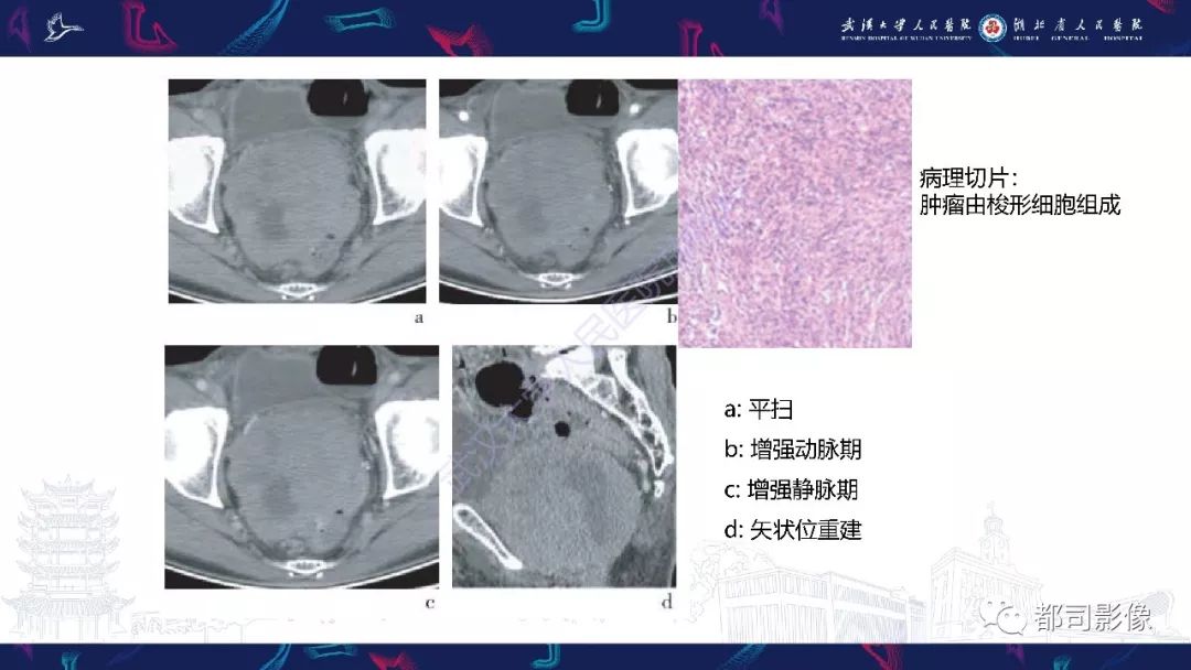 【PPT】前列腺胃肠外间质瘤影像诊断