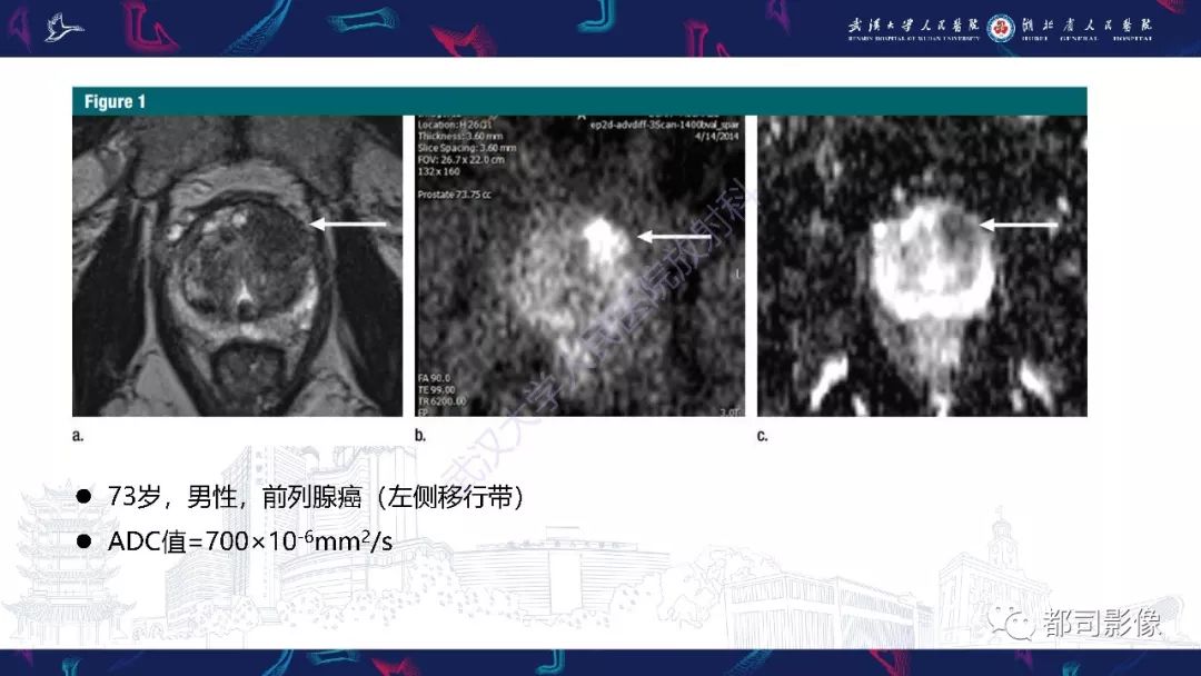 【PPT】前列腺胃肠外间质瘤影像诊断