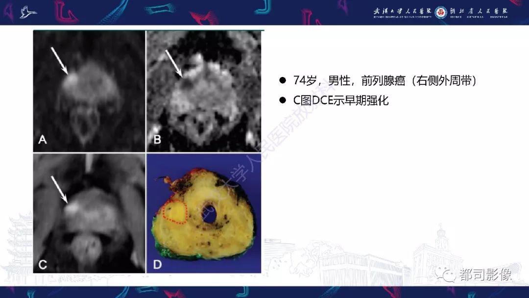 【PPT】前列腺胃肠外间质瘤影像诊断