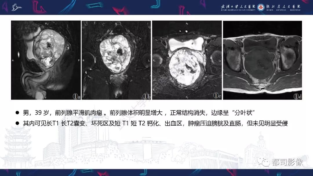 【PPT】前列腺胃肠外间质瘤影像诊断