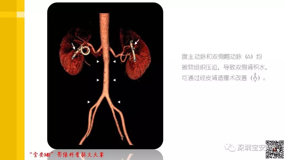 【PPT】腹膜后纤维化的影像诊断