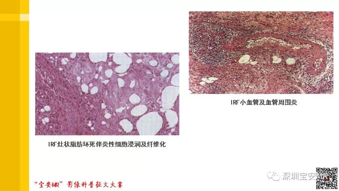 【PPT】腹膜后纤维化的影像诊断