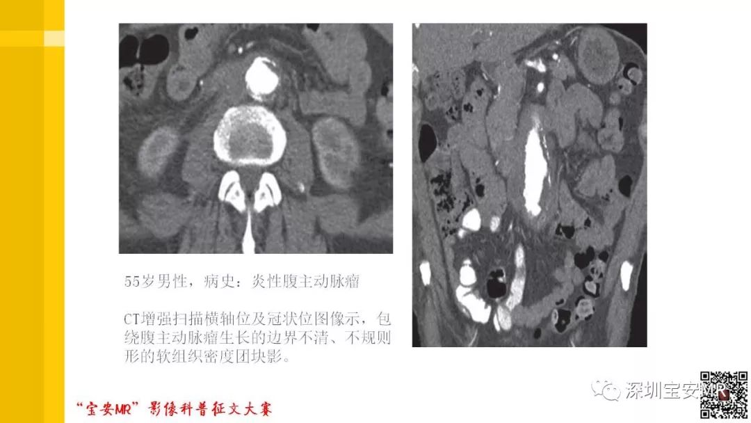 【PPT】腹膜后纤维化的影像诊断