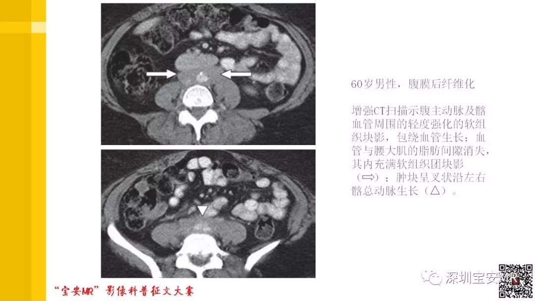 【PPT】腹膜后纤维化的影像诊断