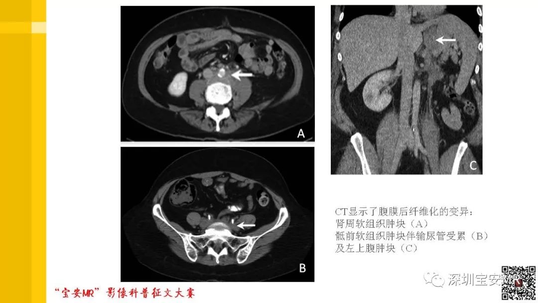 【PPT】腹膜后纤维化的影像诊断