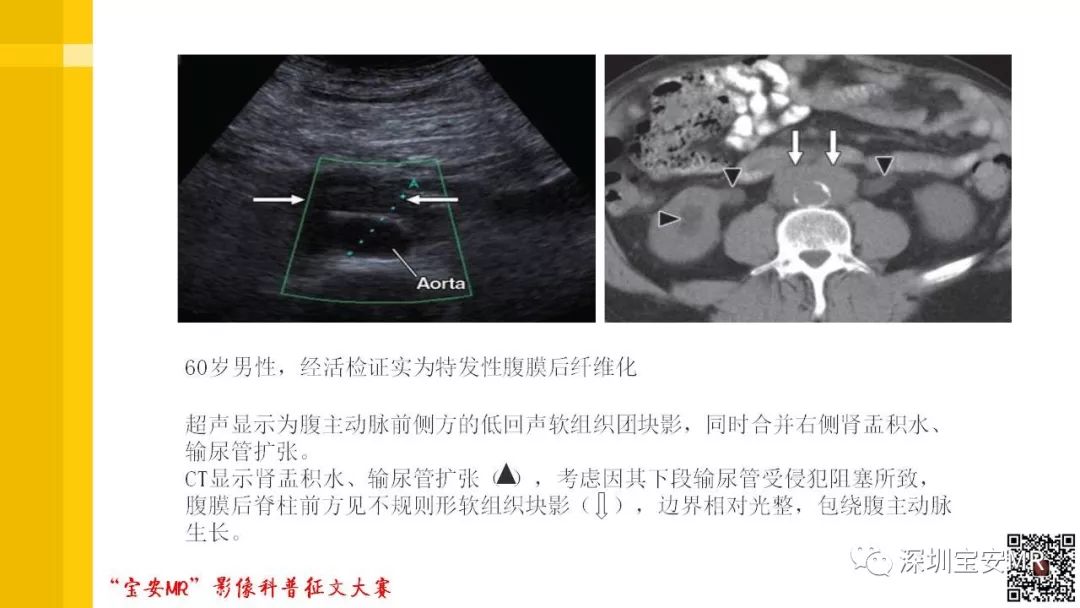 【PPT】腹膜后纤维化的影像诊断
