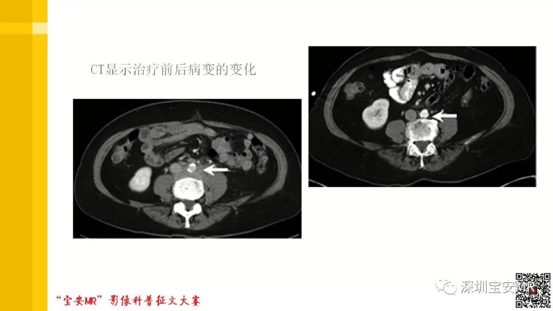 【PPT】腹膜后纤维化的影像诊断