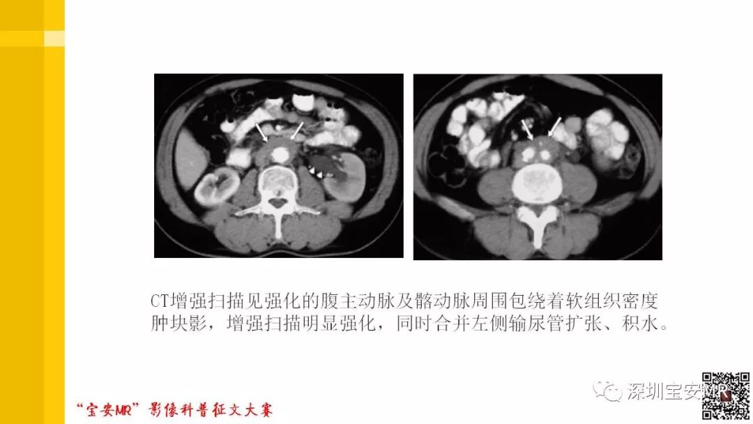 【PPT】腹膜后纤维化的影像诊断
