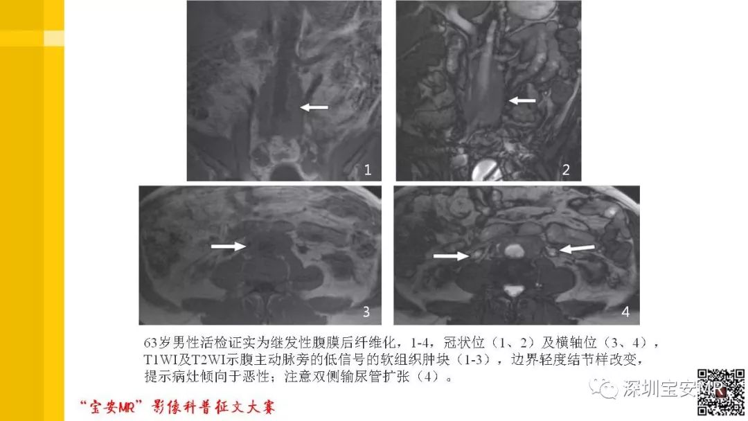 【PPT】腹膜后纤维化的影像诊断