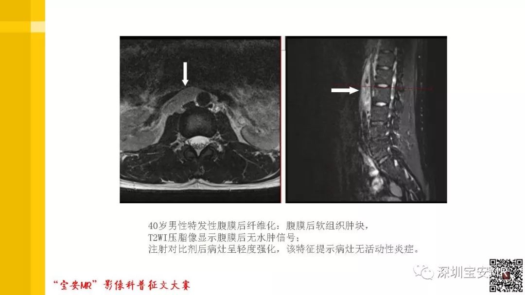 【PPT】腹膜后纤维化的影像诊断